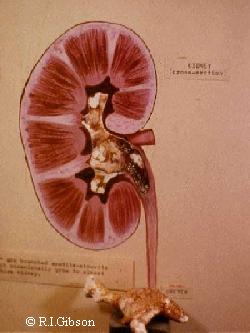 Staghorn Kidney Stones